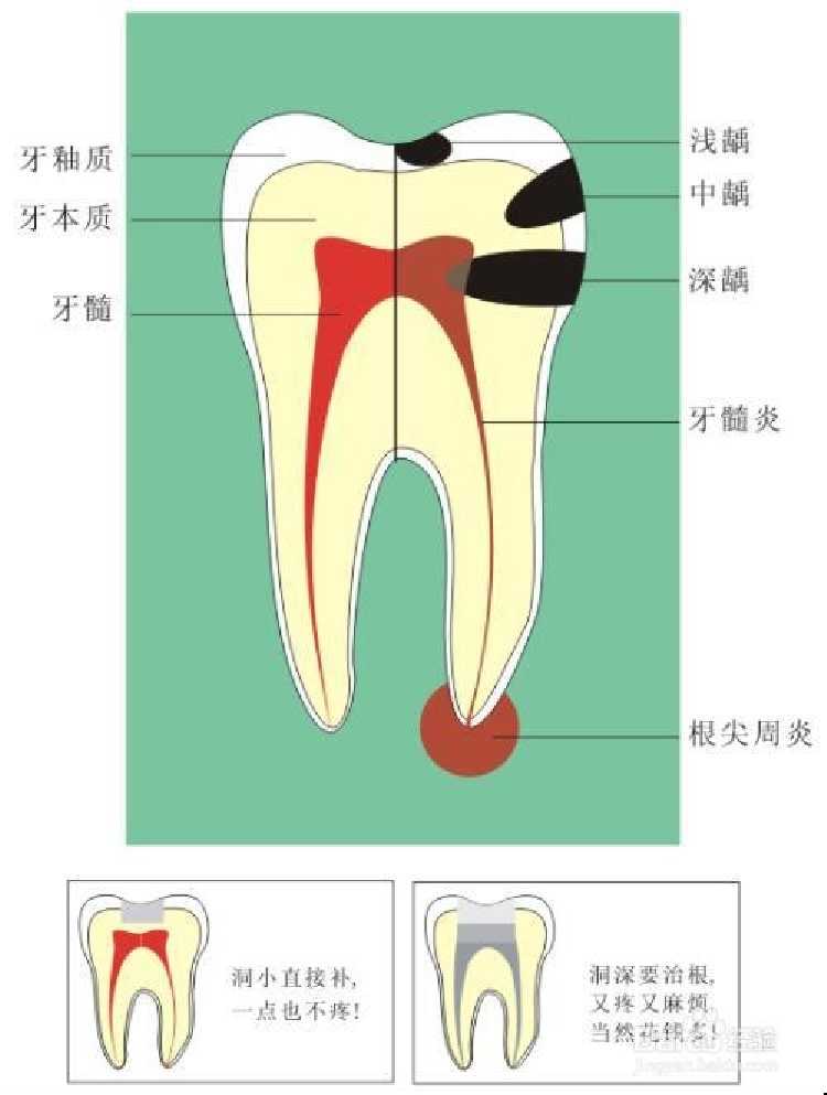 2.防治牙周炎